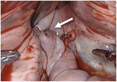 Concomitant intra-atrial excision of the left atrial appendage during robotic-assisted minimally invasive cardiac surgery